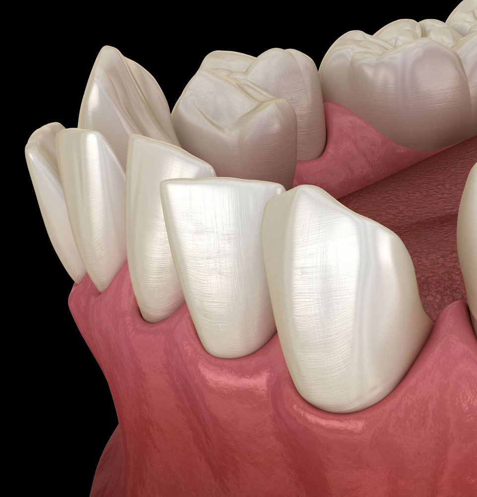 crooked teeth Invisalign