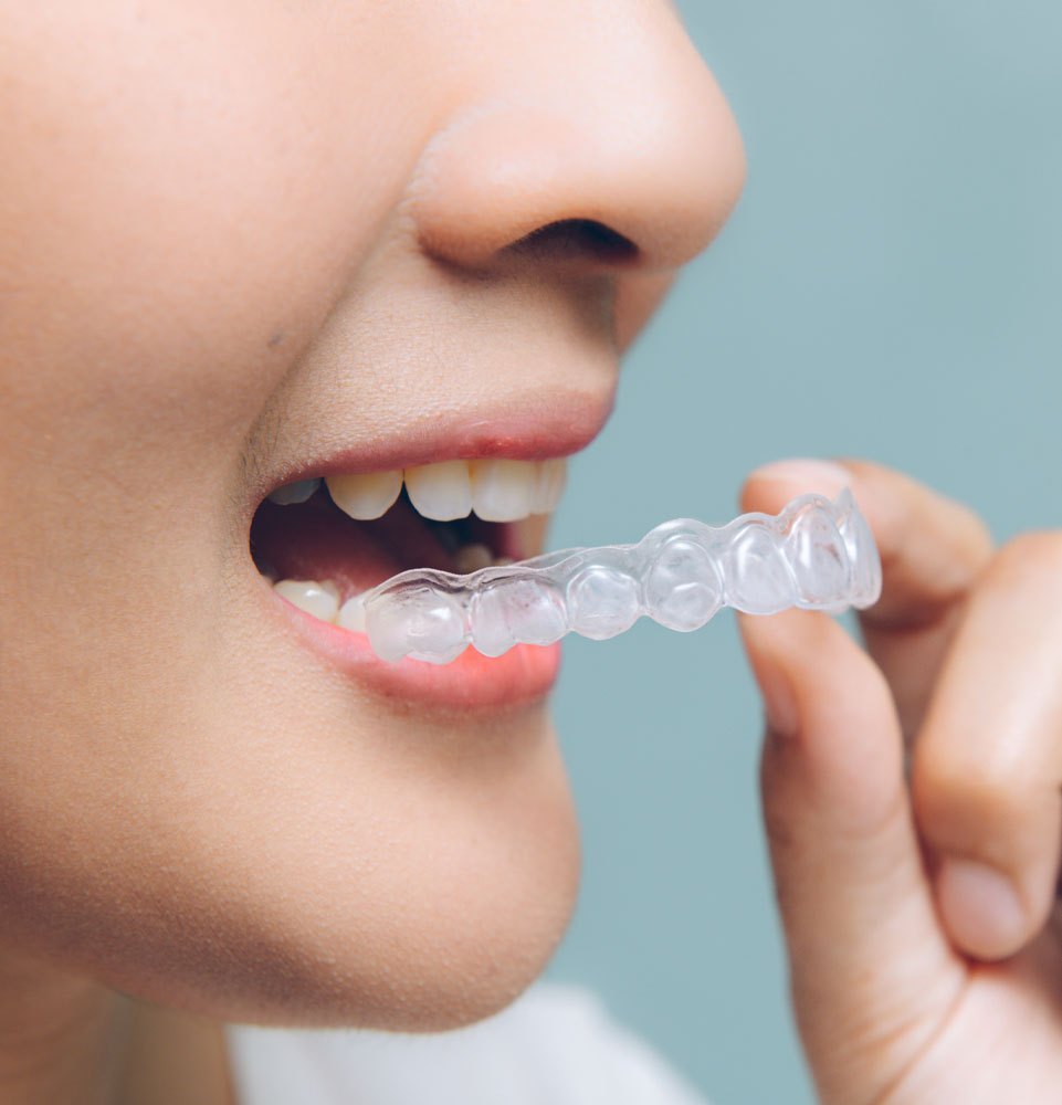 invisalign patient with aligners